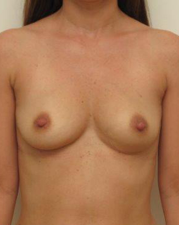 Ultra High Profile Silicone Implants Before and After | CIARAVINO Plastic Surgery & Med Spa