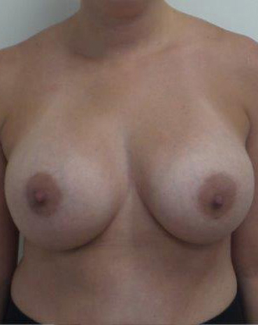 Ultra High Profile Silicone Implants Before and After | CIARAVINO Plastic Surgery & Med Spa