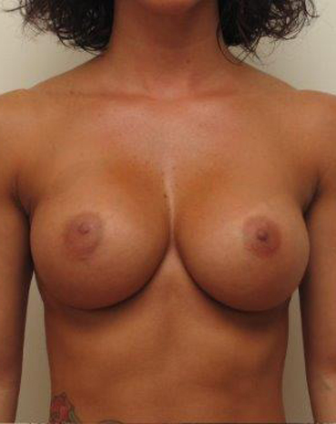 Ultra High Profile Silicone Implants Before and After | CIARAVINO Plastic Surgery & Med Spa