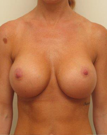Ultra High Profile Silicone Implants Before and After | CIARAVINO Plastic Surgery & Med Spa