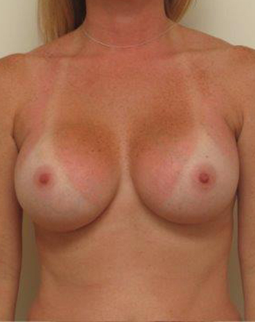 Ultra High Profile Silicone Implants Before and After | CIARAVINO Plastic Surgery & Med Spa