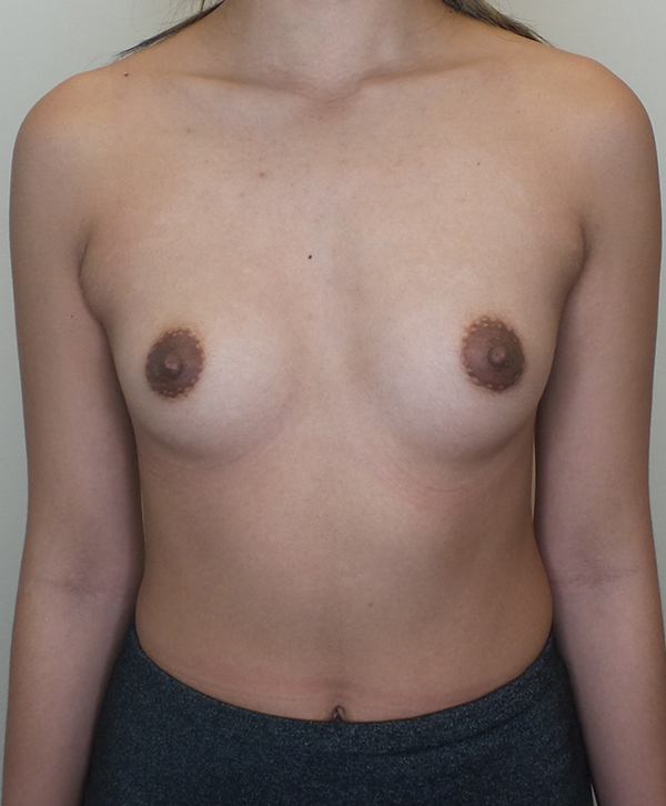 Ultra High Profile Silicone Implants Before and After | CIARAVINO Plastic Surgery & Med Spa