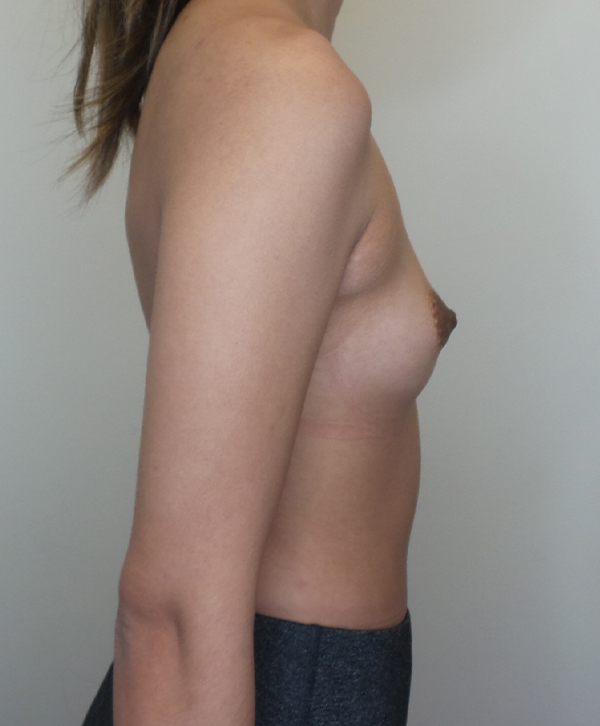 Ultra High Profile Silicone Implants Before and After | CIARAVINO Plastic Surgery & Med Spa